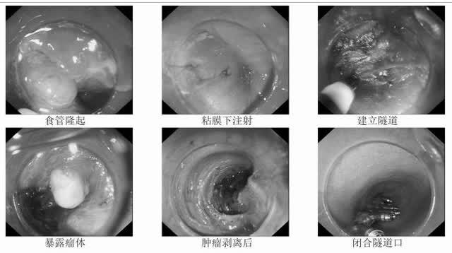 红河州肿瘤医院开全州食道STER手术先河 ，患者免开胸切除食道肿物