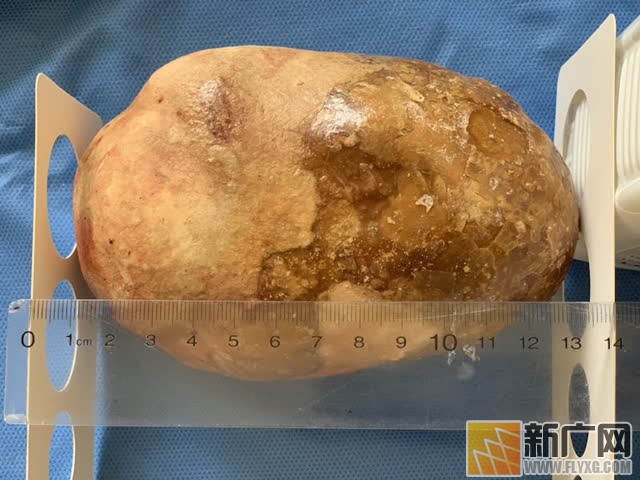 红河老乡到医院取膀胱结石，形同大洋芋体如鸵鸟蛋