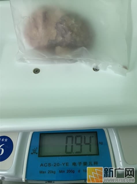 红河老乡到医院取膀胱结石，形同大洋芋体如鸵鸟蛋