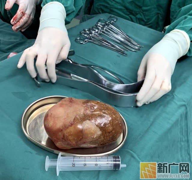 红河老乡到医院取膀胱结石，形同大洋芋体如鸵鸟蛋