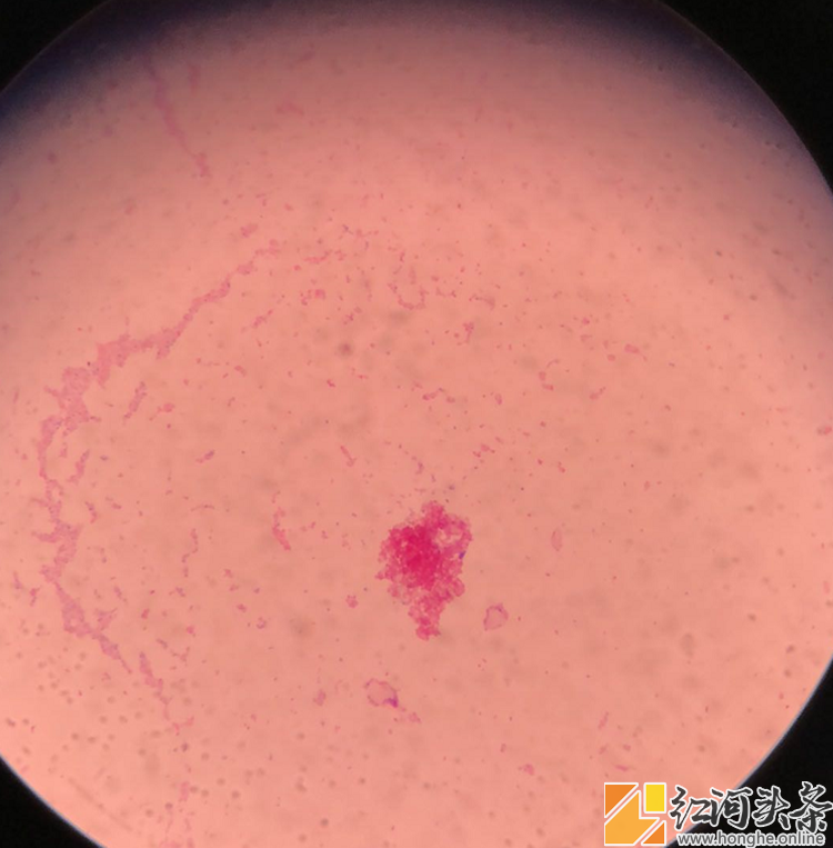 个旧：五旬男子莫名发热，竟因食用生羊血这道“美食”！