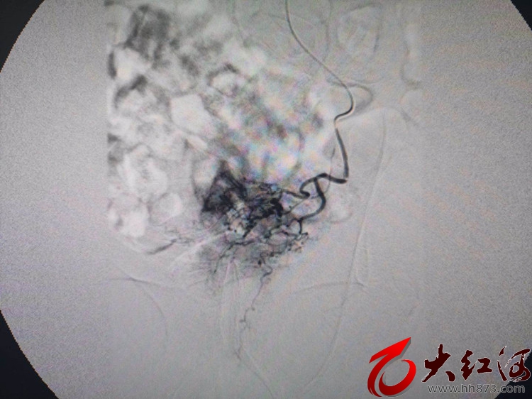 红河州肿瘤医院不开刀的手术医生  致力于探索和开创肿瘤治疗新模式