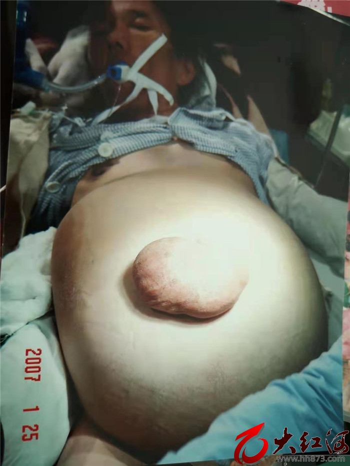 红河州第三人民医院多学科联合切除直径40.7厘米的妇瘤大如西瓜