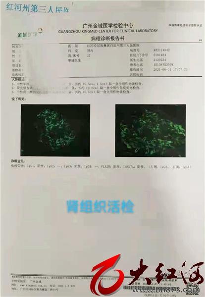 红河州第三医院成功诊治一例少见IgG4相关疾病 国内仅为个案报道