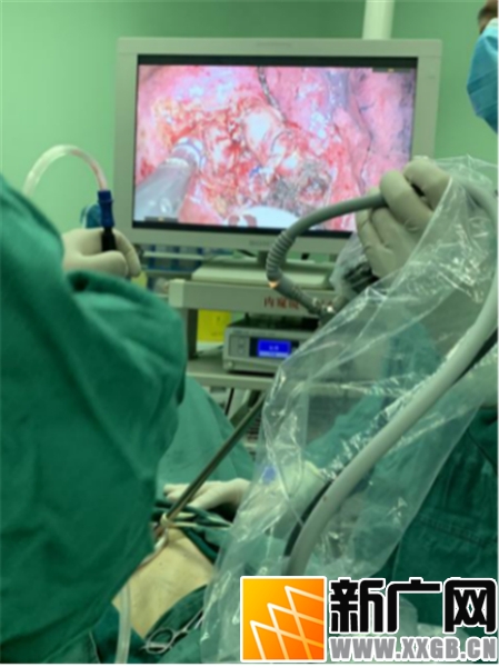 红河州肿瘤医院一个孔救了一位肺癌大爷 老人家说一年多来感觉良好