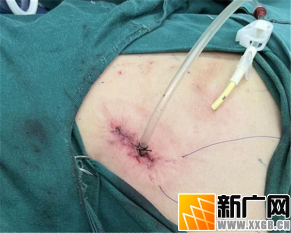 红河州肿瘤医院一个孔救了一位肺癌大爷 老人家说一年多来感觉良好