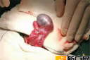 10岁男孩哭嚷“蛋蛋”疼痛：红河州第三人民医院40分钟拯救睾丸