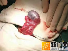 10岁男孩哭嚷“蛋蛋”疼痛：红河州第三人民医院40分钟拯救睾丸