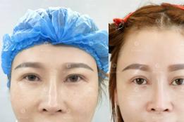 重塑上庭年轻架构，内窥镜额部提升告别眉压眼老态
